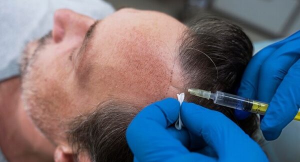 Die 10 besten Haartransplantationsärzte in Berlin