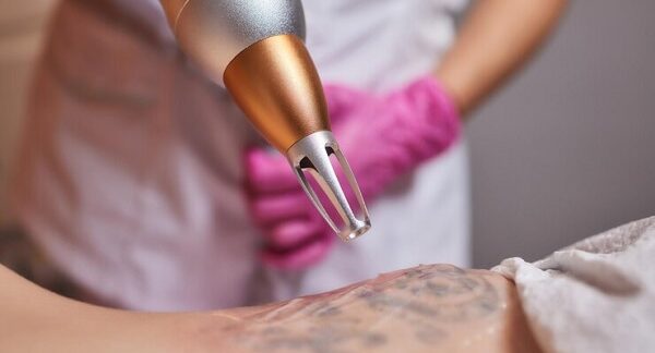Die 10 besten Tattooentfernungszentren in Berlin
