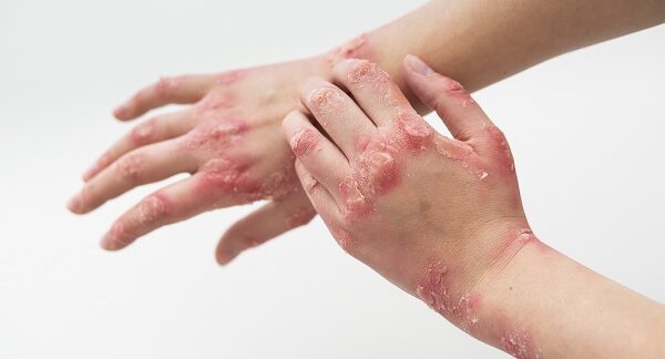 Die 10 besten Psoriasis-Zentren in Berlin